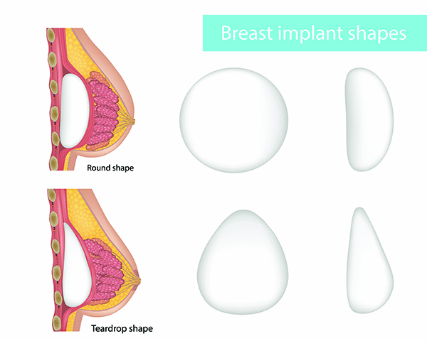 breast implants