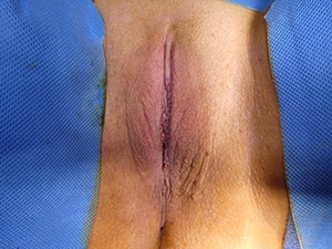 labiaplasty-patient-14-a