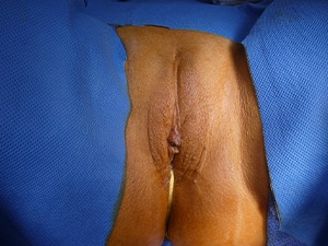 labiaplasty-patient-14-b