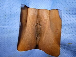 vaginoplasty-patient-14-b